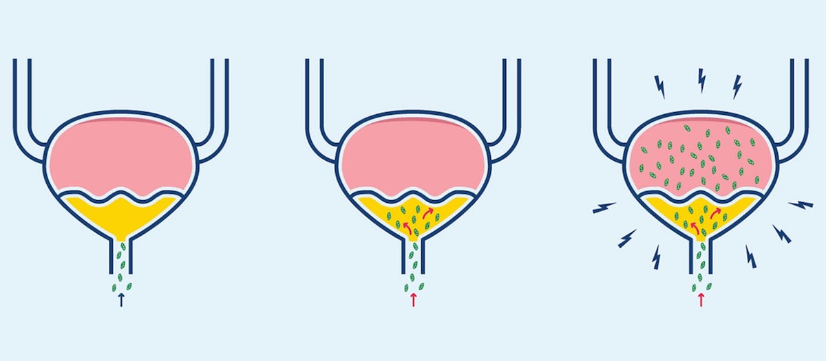 how-long-does-uti-last-the-detox-cafe